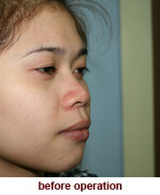 plastic_surgery_augmentation_rhinoplasty